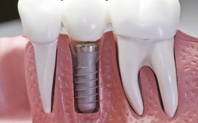 Repair & Renew — How Dental Crowns Can Save Your Teeth